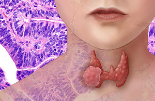 Read more about the article Thyroid “Lumps”