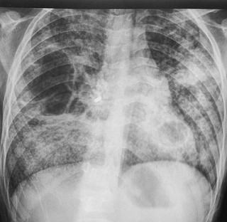 Healed from Tuberculosis 6 - The Crossover Project 19833190659 455f0926dd n - The Crossover Project