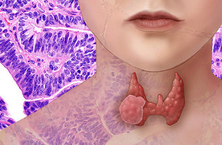 Thyroid "Lumps" 10 - The Crossover Project 28266028855 0af2c57df8 n - The Crossover Project