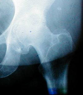 Hip Pain Gone 7 - The Crossover Project 91201734 33ae99afe4 n - The Crossover Project